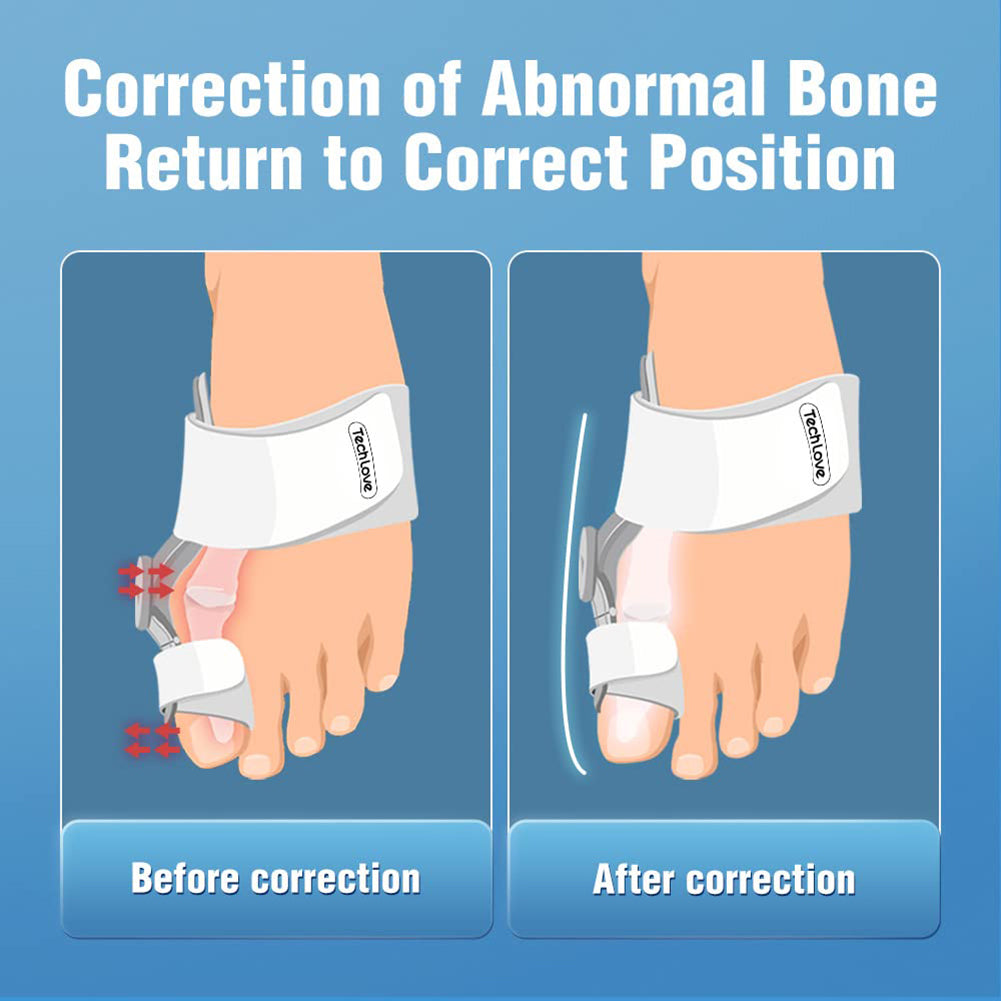 Bunion Corrector™